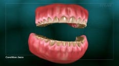 Bruxism (Clenching And Grinding) 005