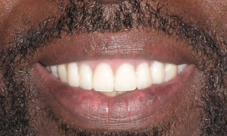 Before and After