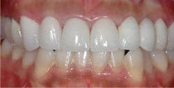 Patient 78165 After Photo