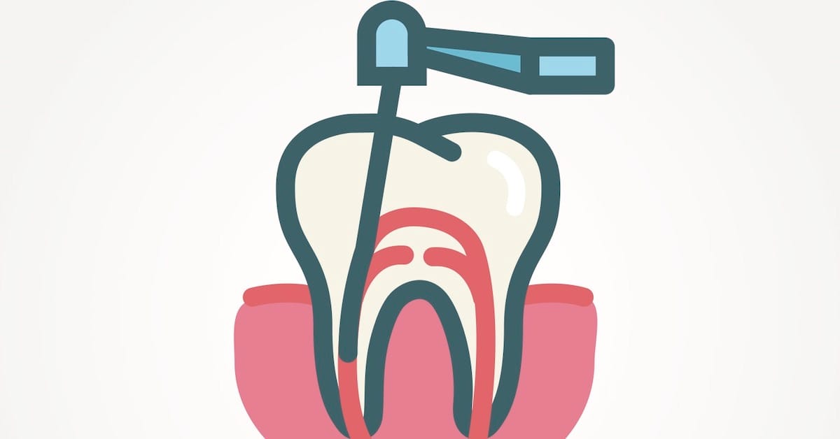 Uncover The Truth About Root Canal Treatment