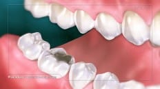 Composite Versus Amalgam Filling 003