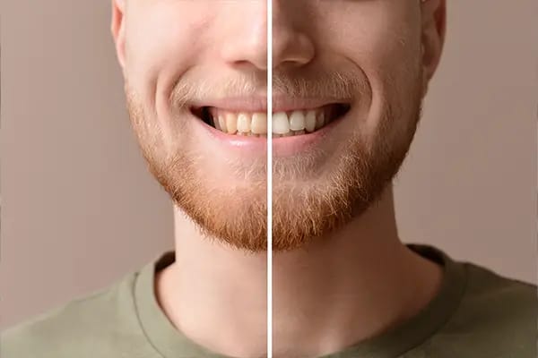 Before and after comparison showing dramatic teeth whitening results
