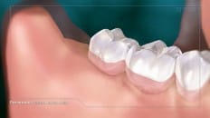 Surgical Extraction (3rd Molar) 005