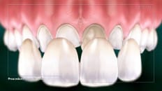 Veneers (Impression) 005