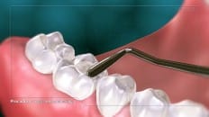 Composite Versus Amalgam Filling 005