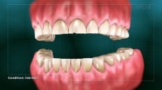 Dental Erosion 001