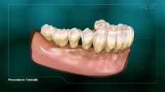 Periodontitis 004