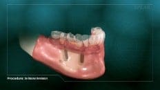 Bar Retained Overdenture 002
