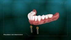 Locator Retained Overdenture 006