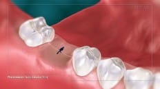 Surgical Extraction (Other) 005