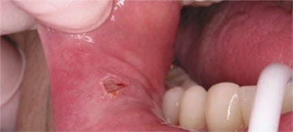 Fibroma1-Res1