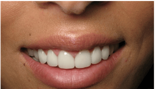Veneers after
