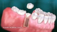 Single Implant (Posterior- Healing Cap) 006