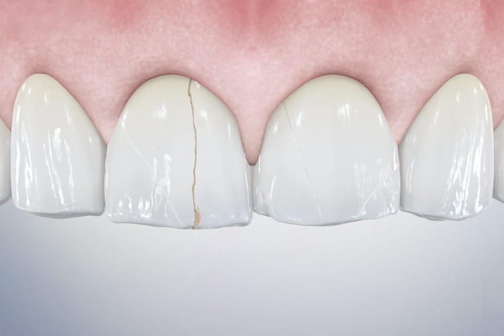 cracked tooth image