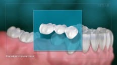Bridge Versus An Implant 002