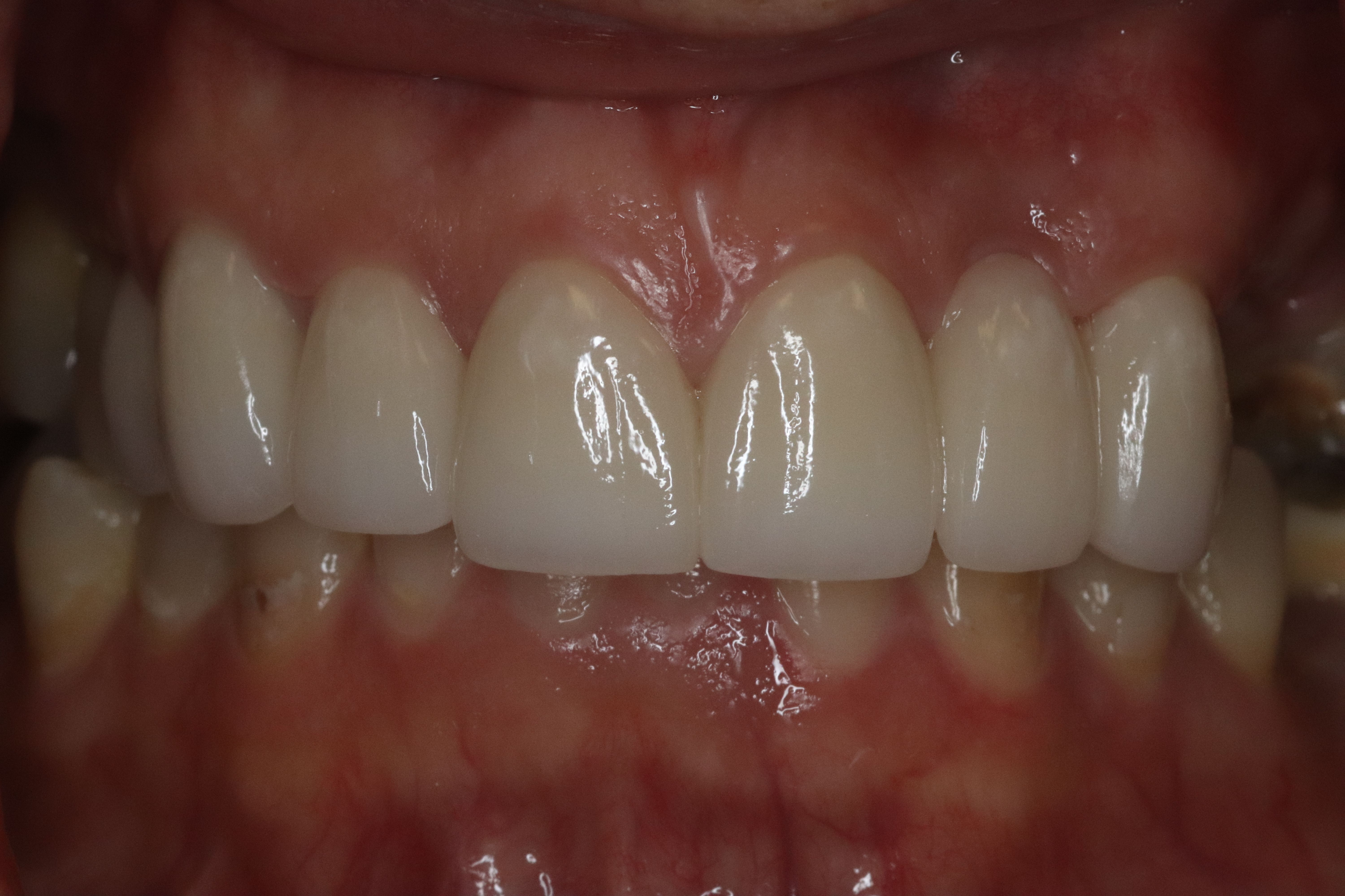 Rasner Smile gallery after 4