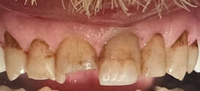 Bright Smiles Marble Falls Case 2 before