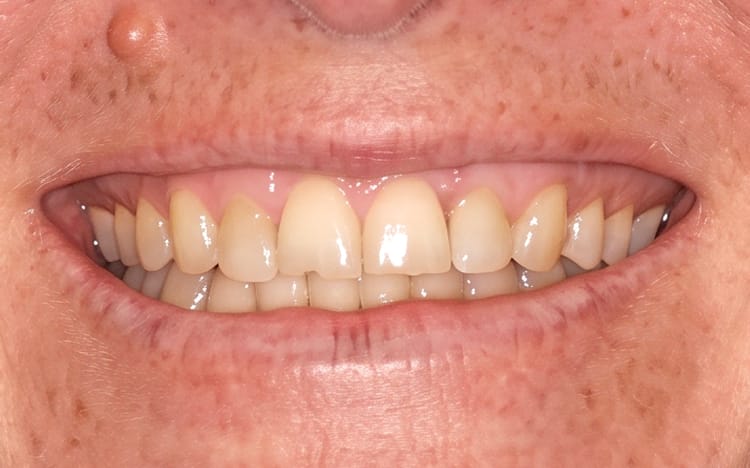 14. Patient RL (9 teeth, 1 implant)_ Porcelain crowns and an implant crown on upper 10 teeth Before