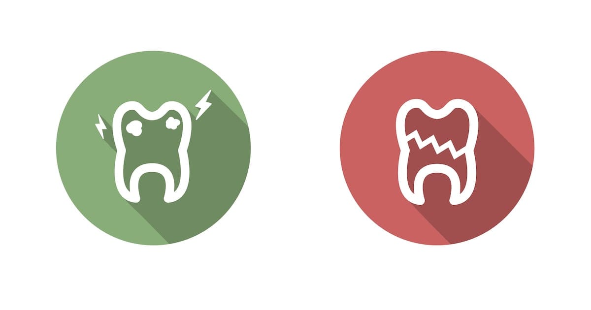 5 Top Treatments for Chipped Teeth