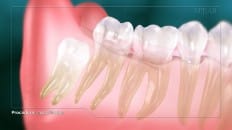 Impacted Third Molar 001