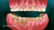 Understanding Tooth Wear 006