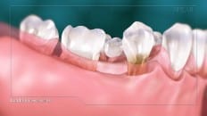 Single Tooth Loss 003