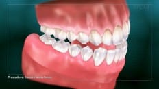 Removable Complete Dentures 006