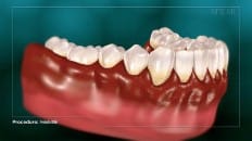 Periodontitis 002