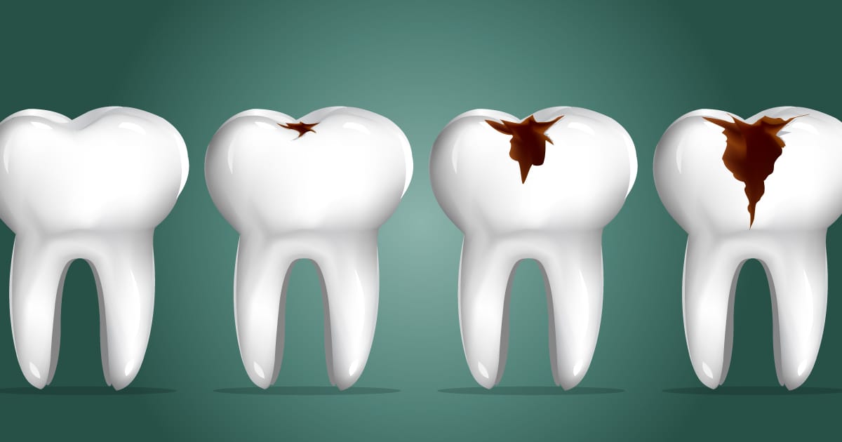 Anorexia and Bulimia Effects on Teeth and Health in Teens and Children
