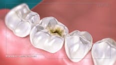 Composite Filling (Posterior) 001