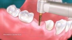 Bridge Versus An Implant 003