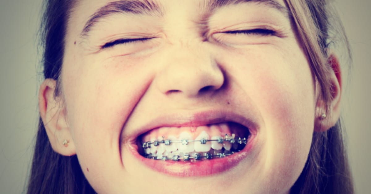 Headgear to Chewing Gum: Taking Care of Teeth with Braces Headgear to Chewing Gum: Taking Care of Teeth with Braces