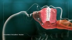 Sleep Appliances - Sleep Apnea 002