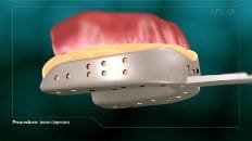 Veneers (Impression) 002