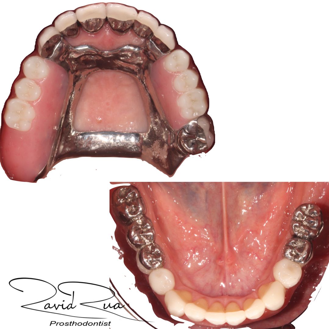 TC Cape Coral Case 8.2 Full mouth rehab with crowns, implants and a top partial