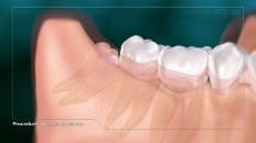 Surgical Extraction (3rd Molar) 001