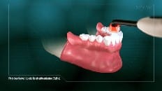 Locator Retained Overdenture (Reline) 008