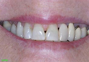 ballston smile gallery case-3-before