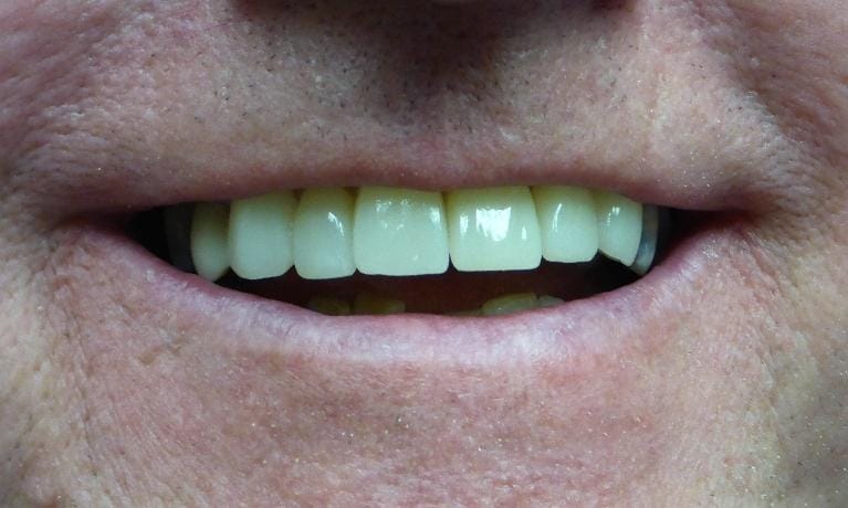 Grapevine After Cosmetic Veneers