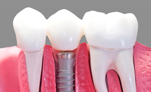 Transforming a Smile with Dental Implants Transforming a Smile with Dental Implants