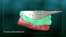 Locator Retained Overdenture (Reline) 005