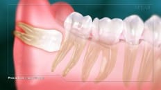 Impacted Third Molar 004
