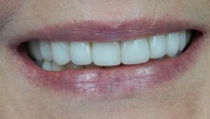 Porcelain Veneers Before