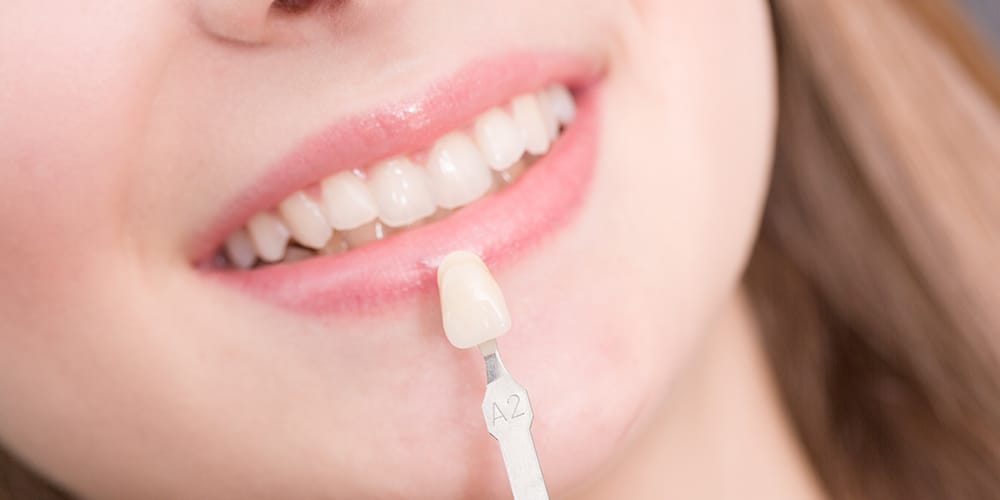 Veneers Veneers