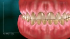 Bruxism (Clenching And Grinding) 004