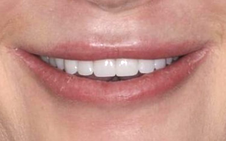 11. Patient KM (8 teeth)_ 8 porcelain crowns on upper front teeth After(1)