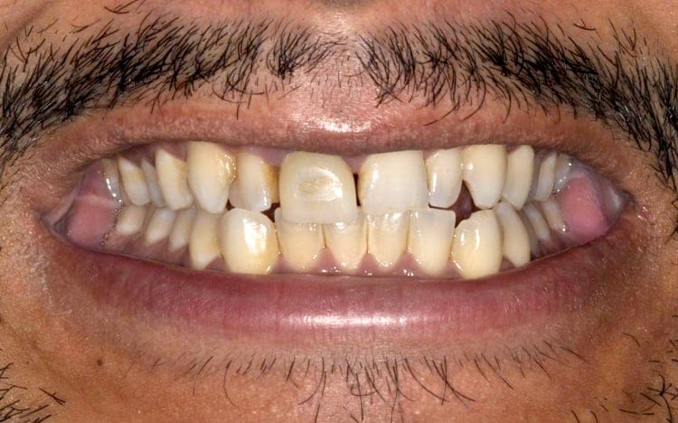 8. Patient J.D_ 2 porcelain crowns for smaller peg lateral teeth, implant front tooth with custom tissue shaping and porcelain implant crown, and front tooth porcelain veneer Before(1)
