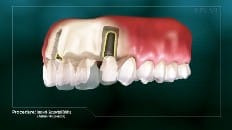Implant-Supported Bridge 002