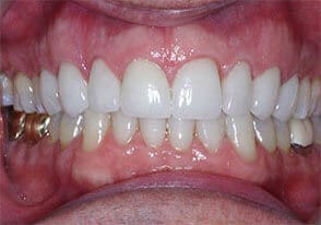 ballston smile gallery case-9-after