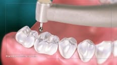 Composite Filling (Posterior) 005